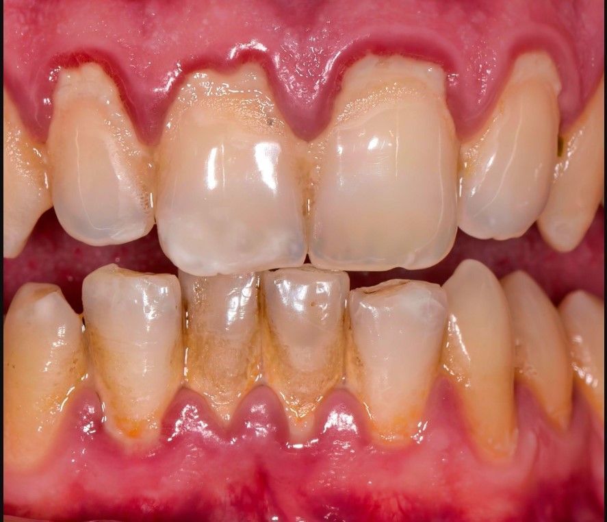 Close-up of teeth and gums showing yellow plaque and tartar buildup along the gumline