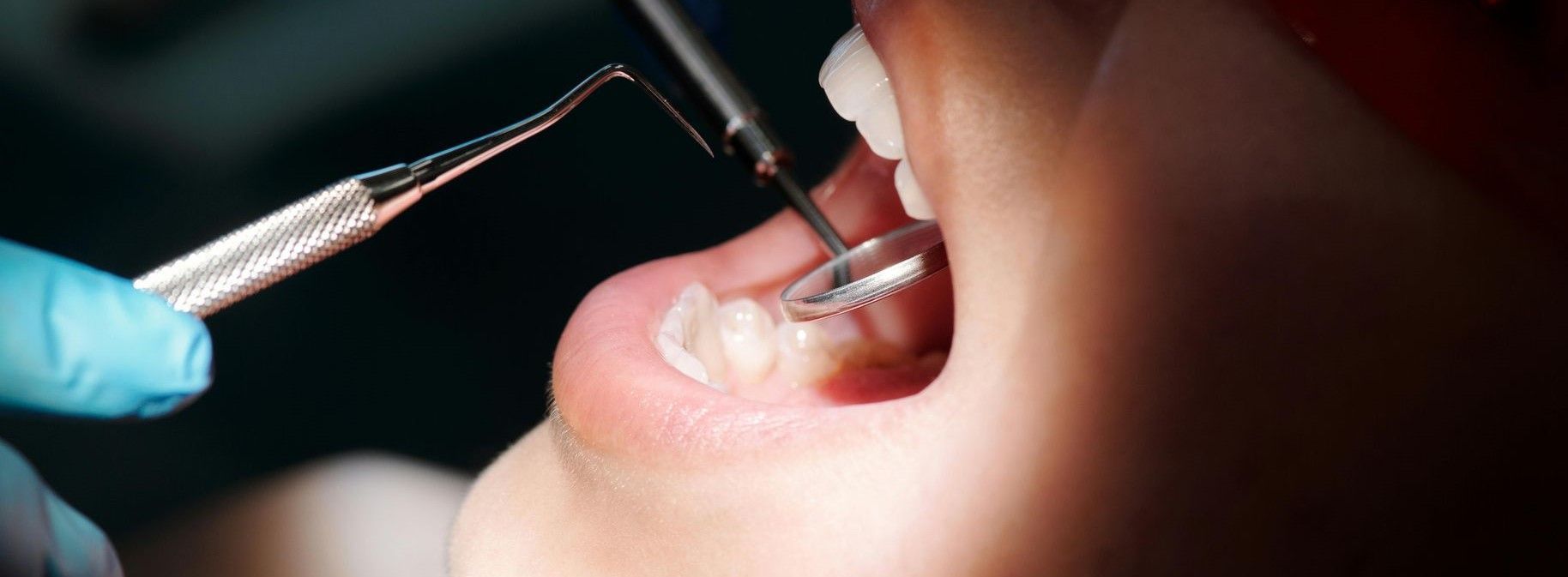 Dentist using a mirror and probe inside a patient’s open mouth during a checkup