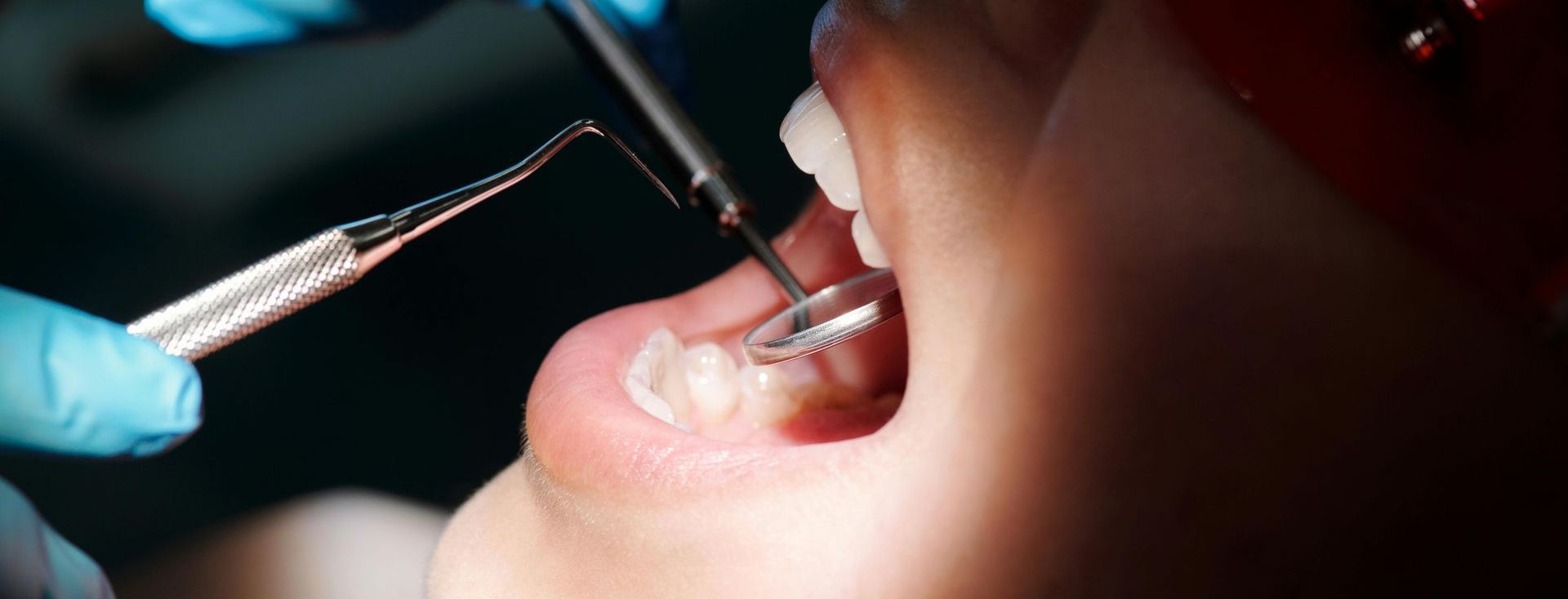 Dental tools examining a patient’s open mouth under bright light