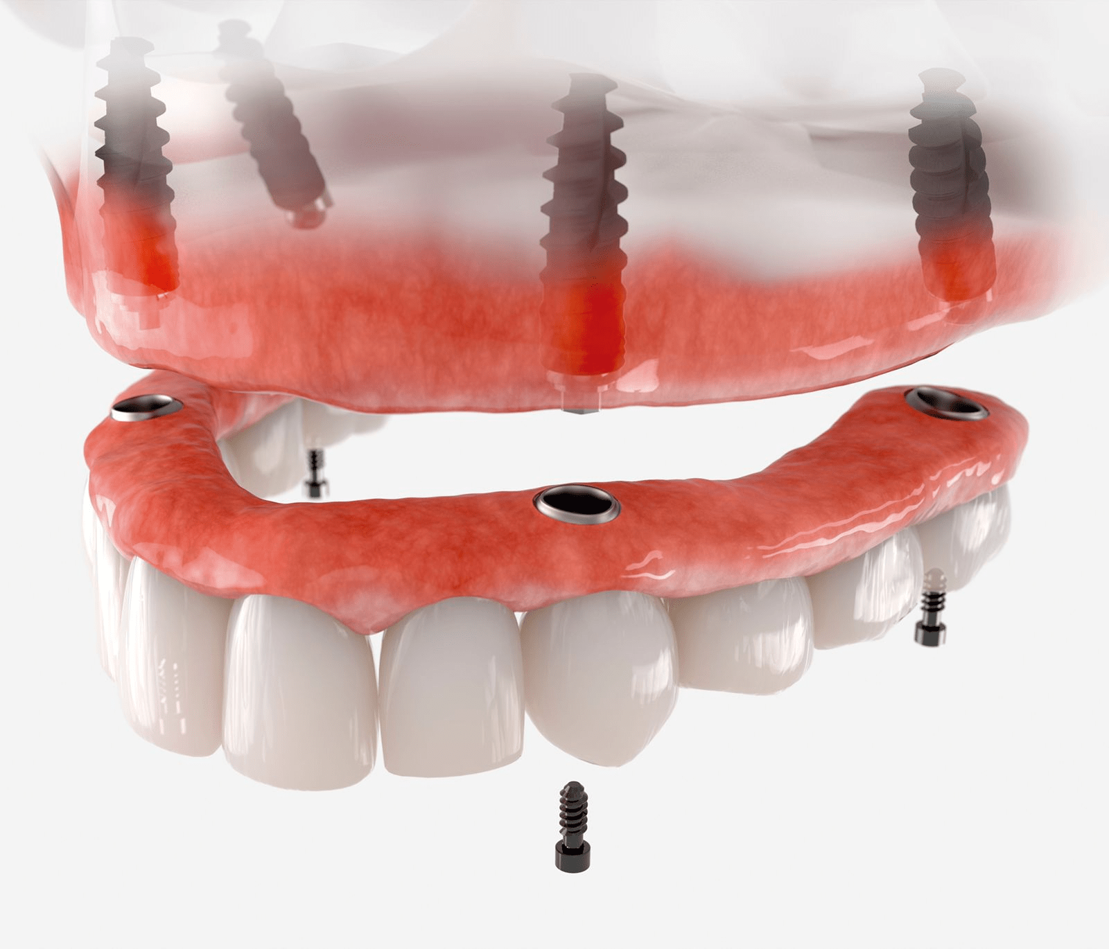 DR. SERGIO SALAS- implantes dentales