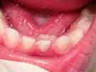 Close-up of a baby's mouth with an inflamed, red lower gum and a white tooth visible