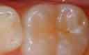 Close-up of teeth with a visible cavity on a molar, slightly blurred