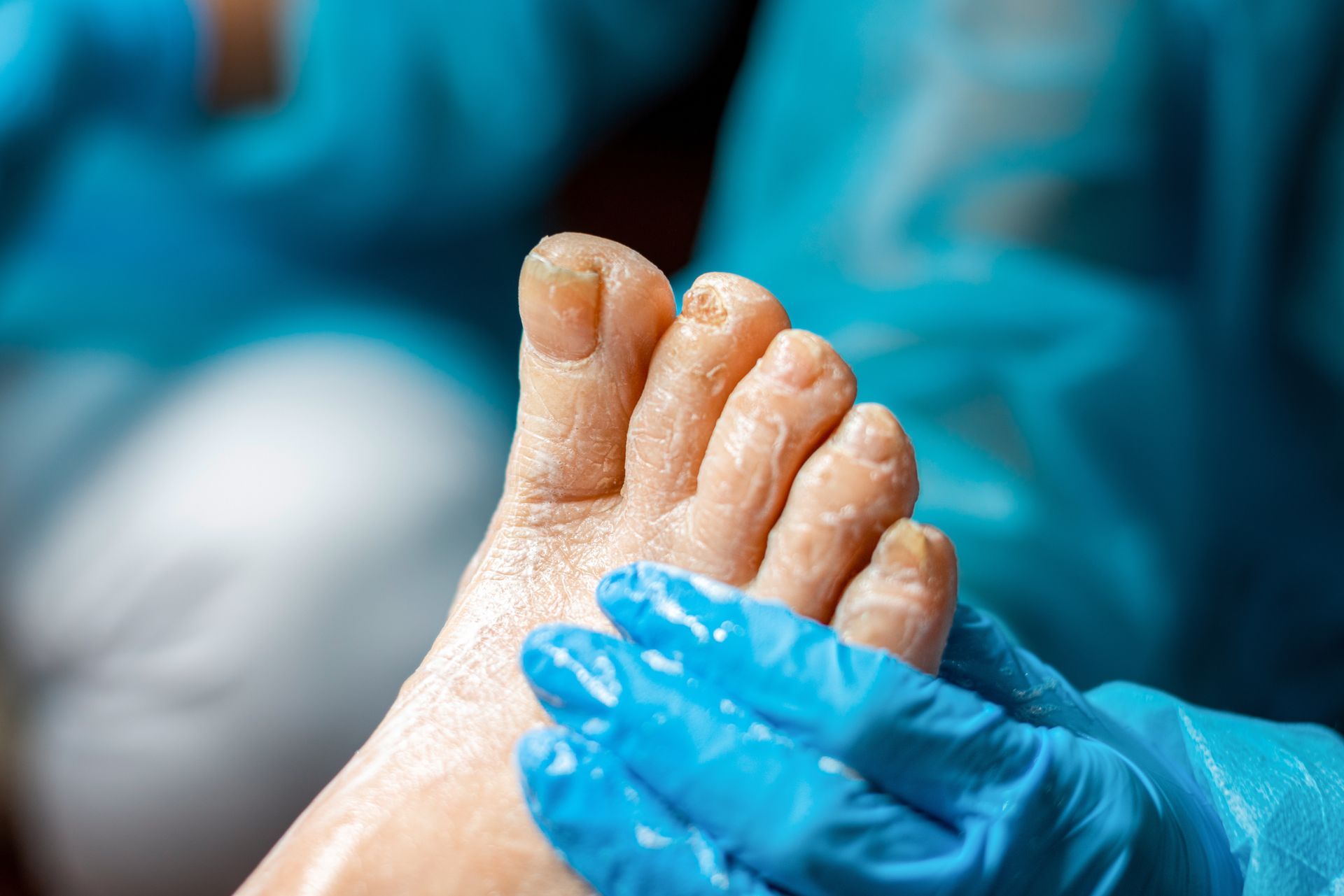 Foot with dry skin and toenail issues being treated by a person wearing blue gloves.