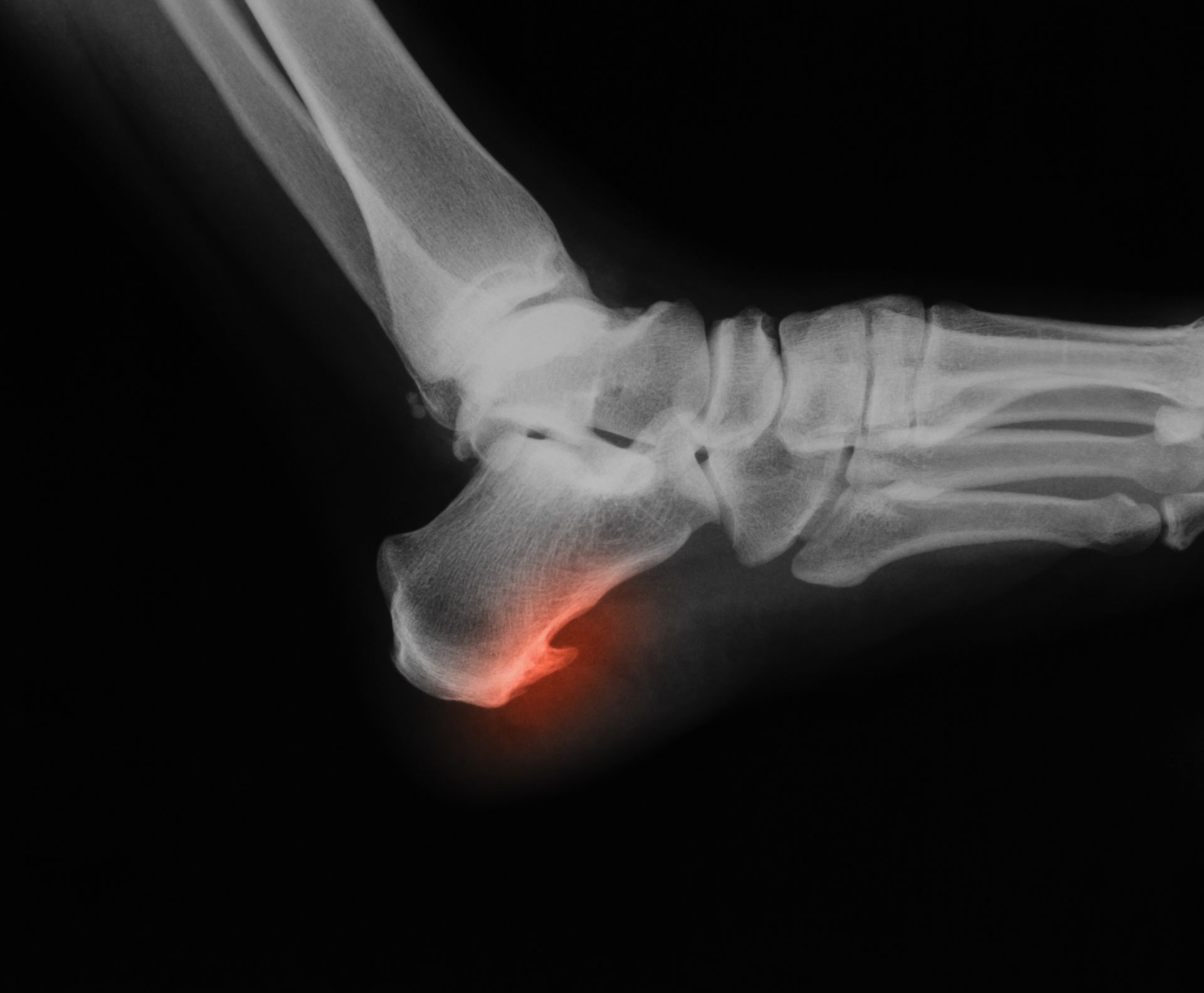 X-ray of a foot, with a highlighted red area at the heel indicating a bone fracture.