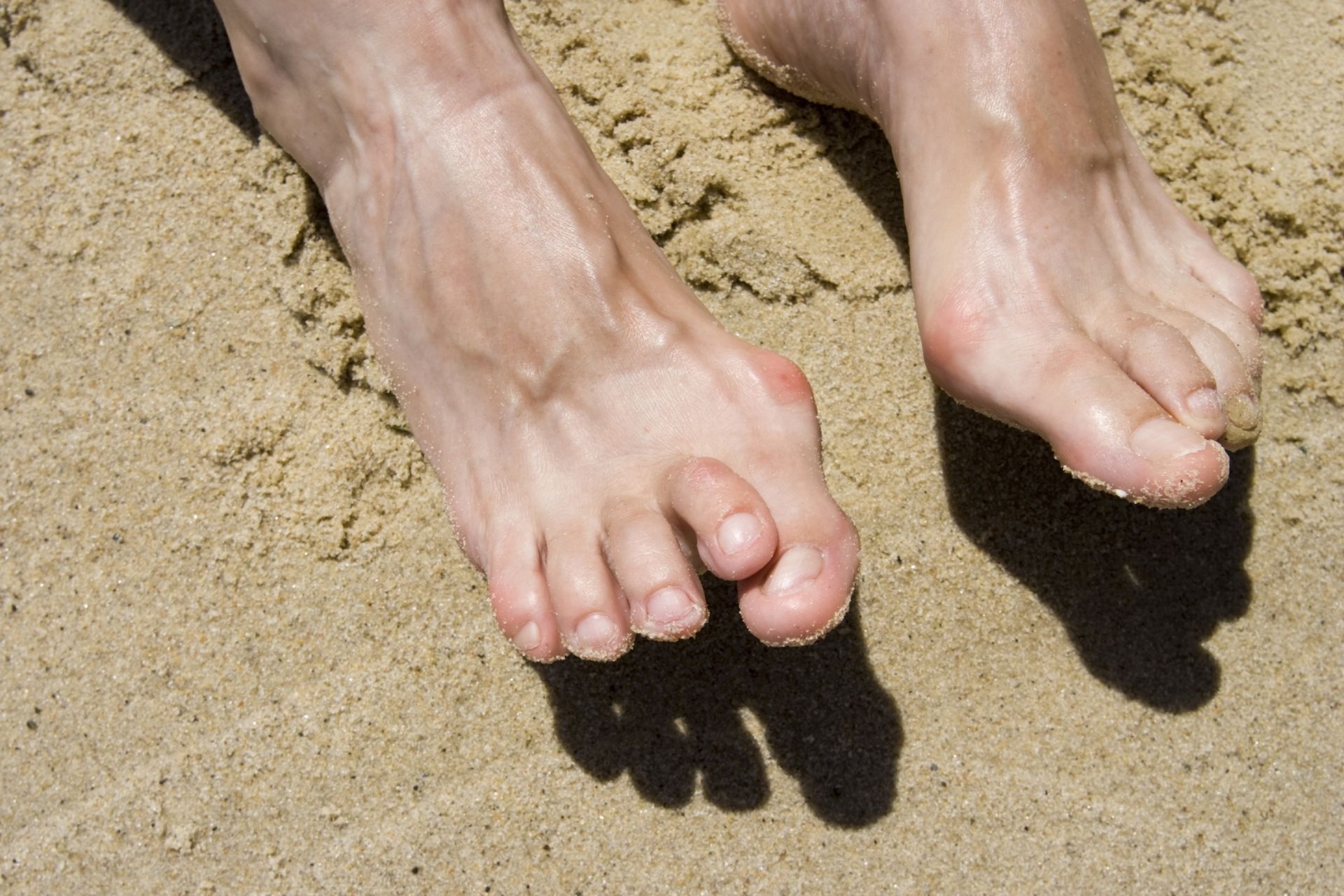 Feet with a bunion on one foot resting on sand.