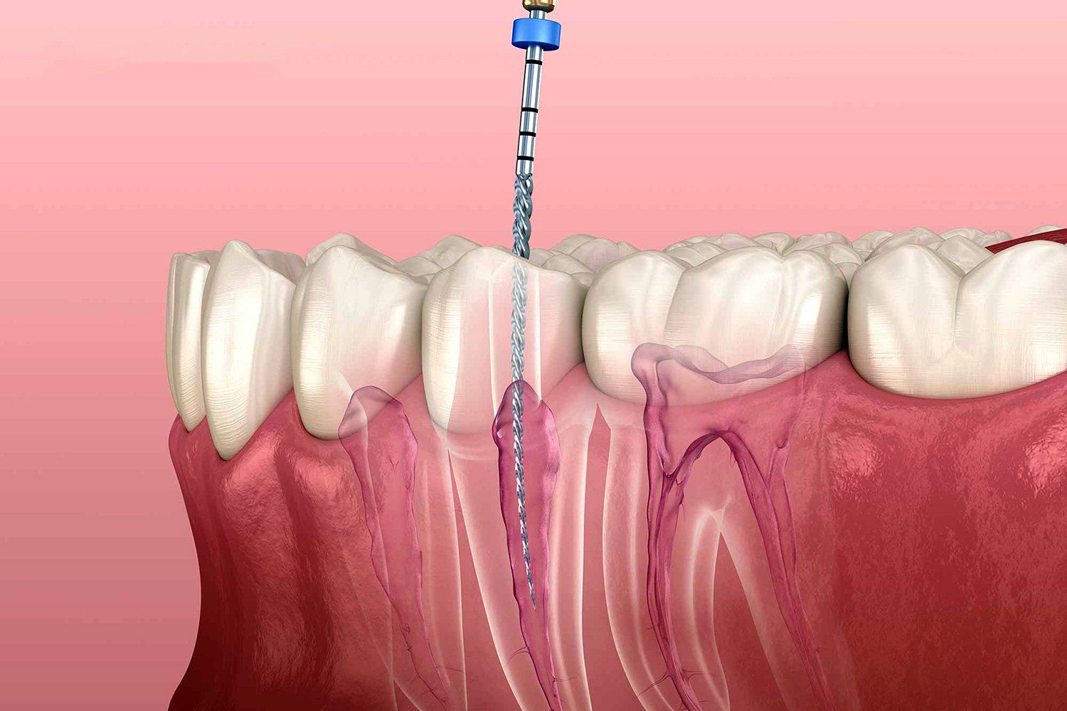 endodonzia