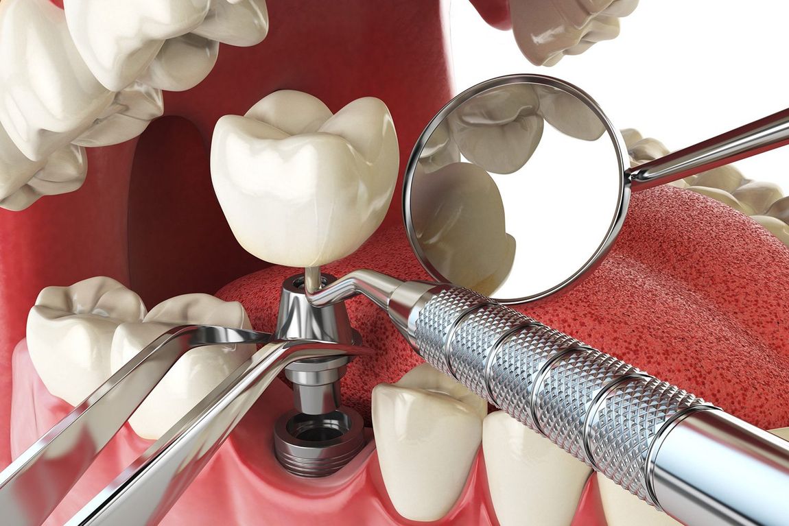 intervento di chirurgia dentale