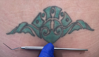 A gloved hand holds a medical instrument against a teal, stylized, symmetrical tribal-style tattoo on skin.