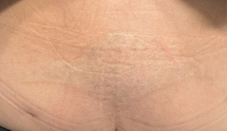 Close-up view of an area of skin on the lower back showing subtle texture and mild hyperpigmentation.