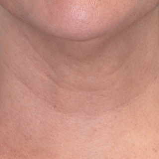A close-up view of a person's neck showing horizontal skin lines and creases.