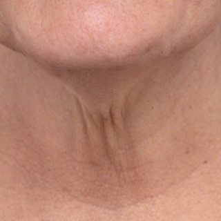 A close-up view of the front of a neck, showing vertical skin folds and horizontal creases.
