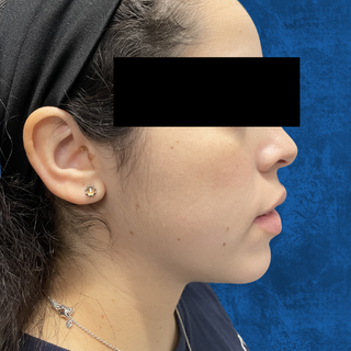 Profile view of a person's face against a dark blue background, highlighting jawline and facial features.