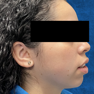 Profile view of a person’s face, focusing on the jawline and chin, against a blue background with eyes redacted.