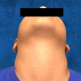 A view from below the chin showing significant, bilateral neck swelling.