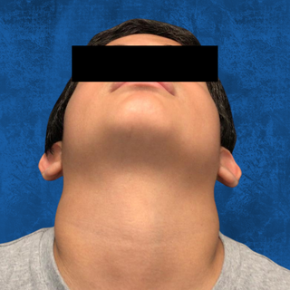 An individual seen from below showing a visible, symmetrical swelling of the thyroid gland in the neck.