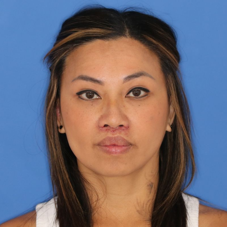 Close up image of a woman's face after lip lift surgery at Carson Williams MD Facial Plastic Surgery office in Leawood KS