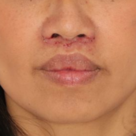 Close up of a woman's face after receiving a lip lift