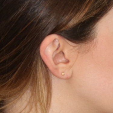 Close up of a person after earlobe repair at Carson Williams Facial Plastic Surgery in Leawood, KS