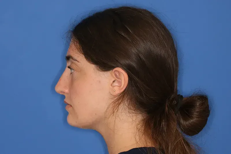 Close up of a woman after Rhinoplasty nose job surgery at Carson Williams Facial Plastic Surgery in Leawood, KS