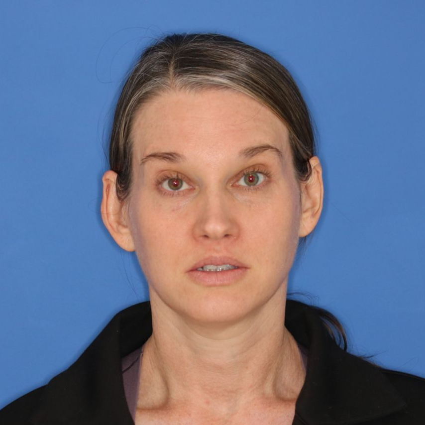 A woman in front of a blue background after receiving CO2 laser treatment
