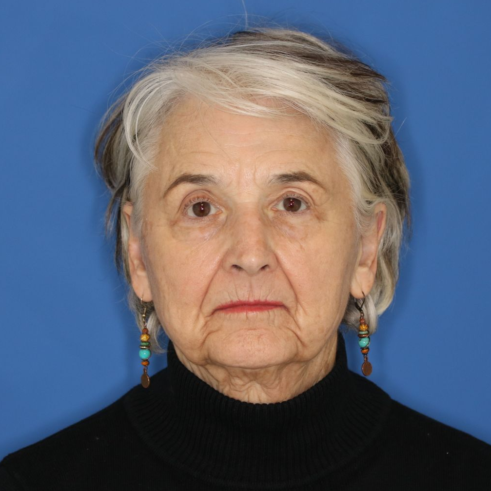 Close up of a woman in front of a blue background posing for an after photo of a CO2 laser treatment
