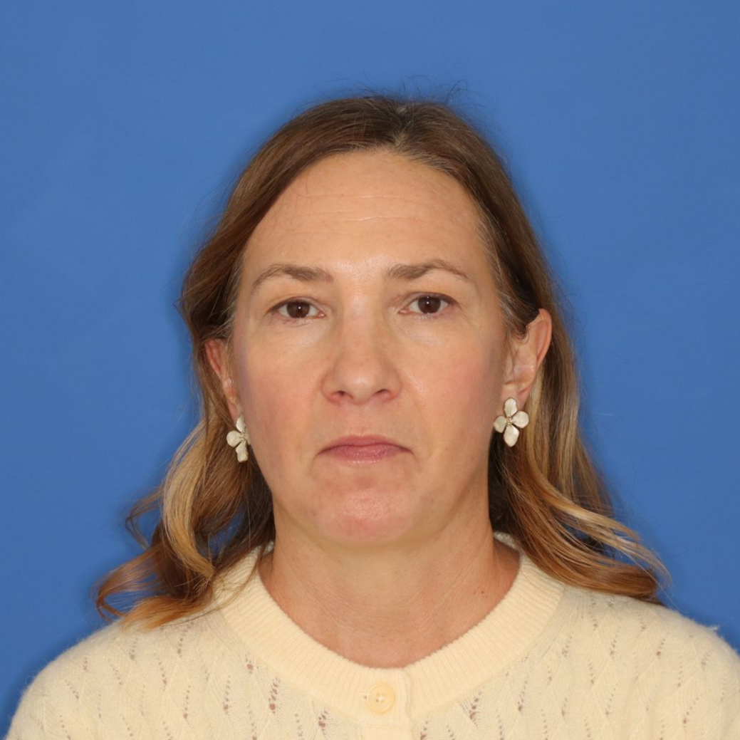 A woman posing for an after photo for CO2 laser treatment