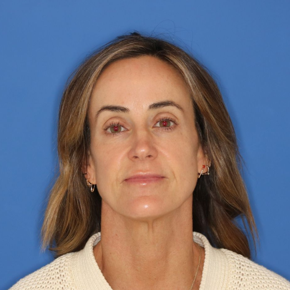 Woman posing for the camera after CO2 treatment