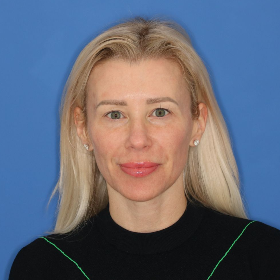 Blonde woman posing in front of a blue background after receiving CO2 laser treatment