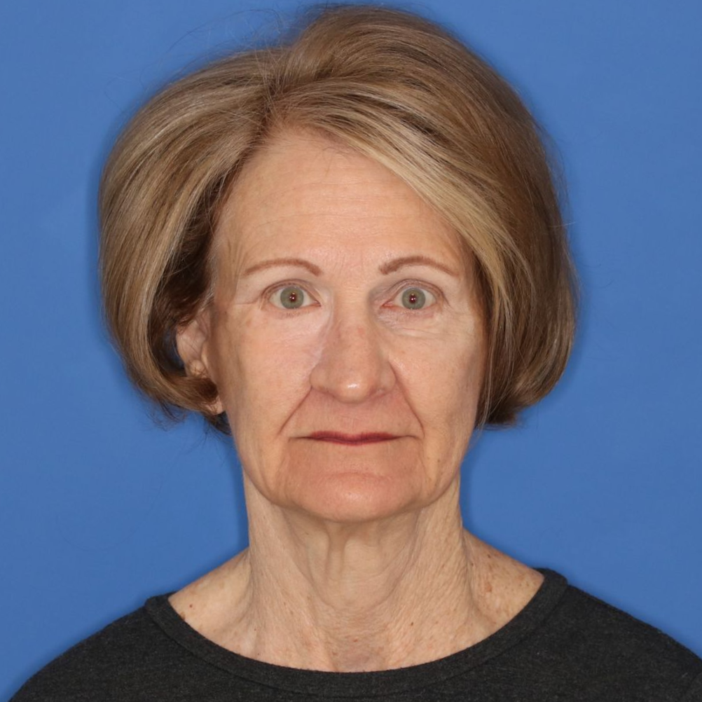 Woman posing for an after photo after receiving CO2 laser treatment