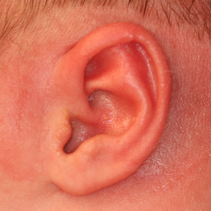 Close up of an infant's ear after EarWell Infant Ear Molding at Carson Williams Facial Plastic Surgery in Leawood, KS