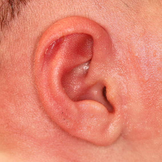 Close up of an infant's ear after EarWell Infant Ear Molding at Carson Williams Facial Plastic Surgery in Leawood, KS