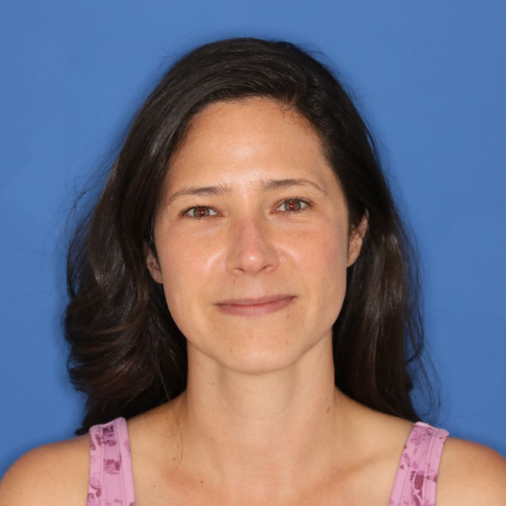 Woman smiling for the camera for an after CO2 laser treatment photo