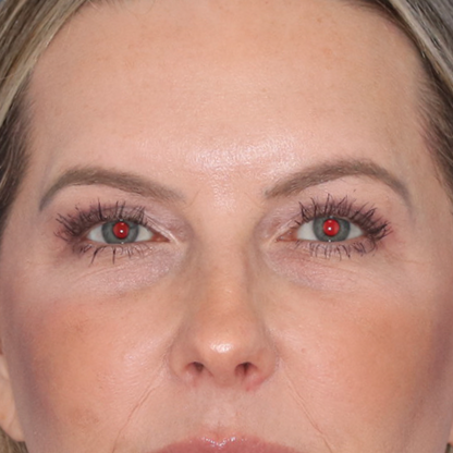 After results of a blepharoplasty on a 52 year old woman