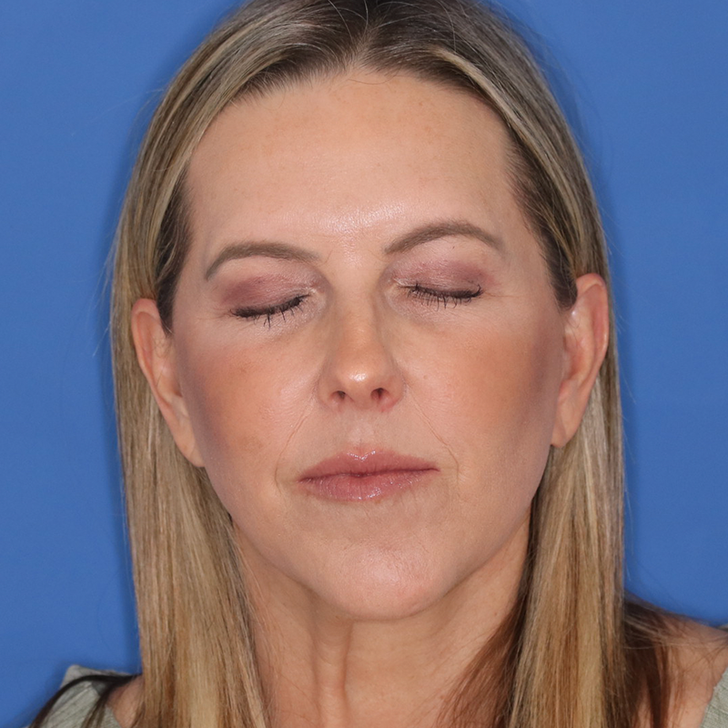 Woman on a blue background showing results of eyelid surgery