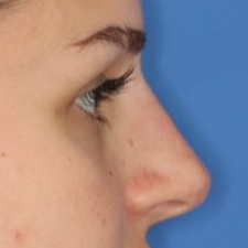 A close up of a young female's nose after undergoing a liquid rhinoplasty