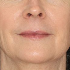 58 year old female underwent upper lip lift in office under local anesthesia.