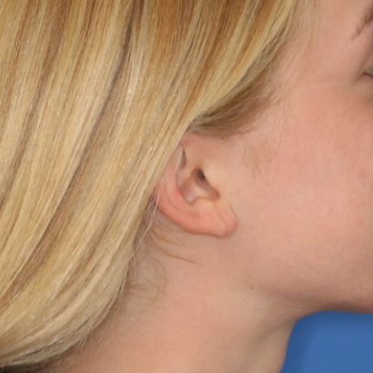 Close up of a person after earlobe repair at Carson Williams Facial Plastic Surgery in Leawood, KS