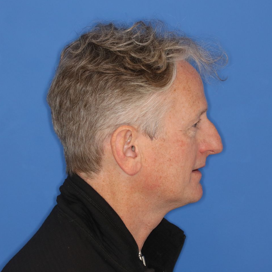 57 year old male posing to the right before undergoing a rhinoplasty