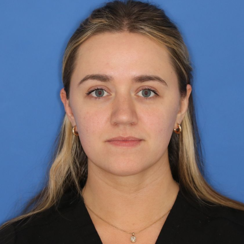 Close up image of a blonde woman's face before rhinoplasty surgery at Carson Williams MD Facial Plastic Surgery office in Leawood KS