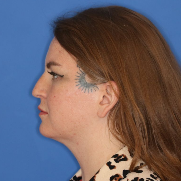 65 year old female underwent deep plane face and neck lift in Leawood, KS