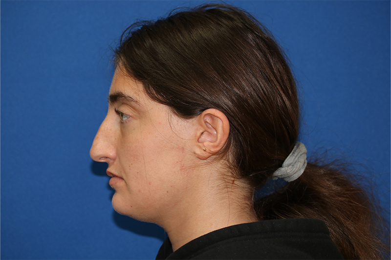 Close up image of a woman's face before rhinoplasty surgery at Carson Williams MD Facial Plastic Surgery office in Leawood KS