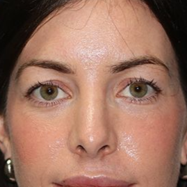 29 year old female who underwent bilateral upper blepharoplasty at Carson Williams Facial Plastic Surgery