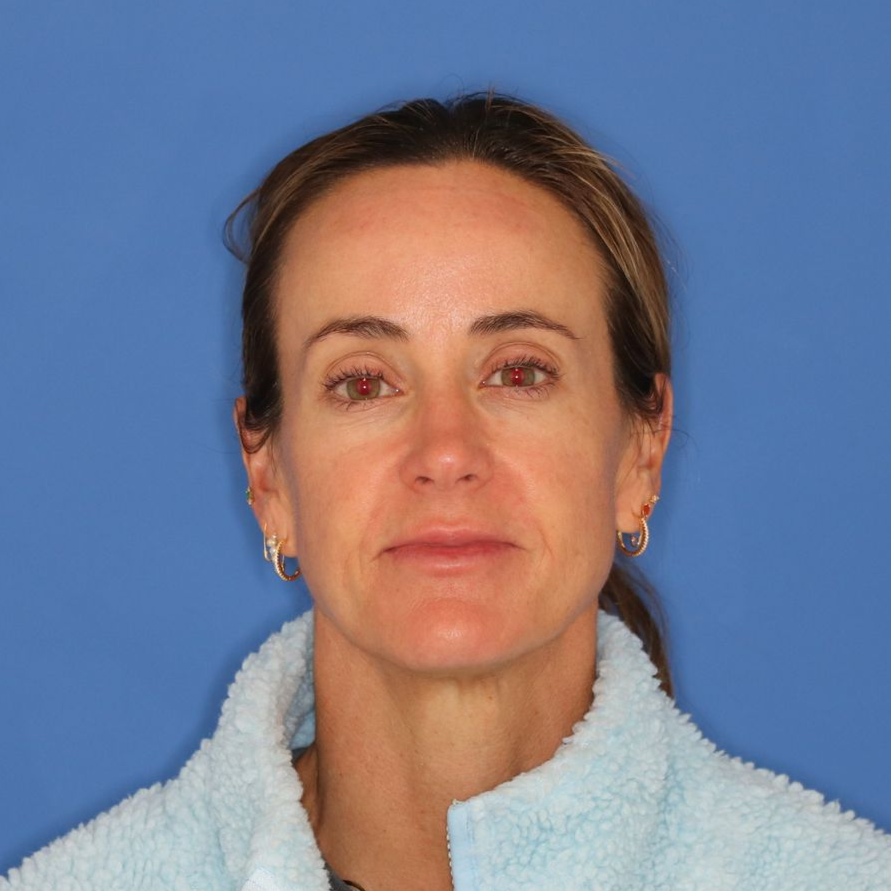 Woman posing for the camera before CO2 treatment