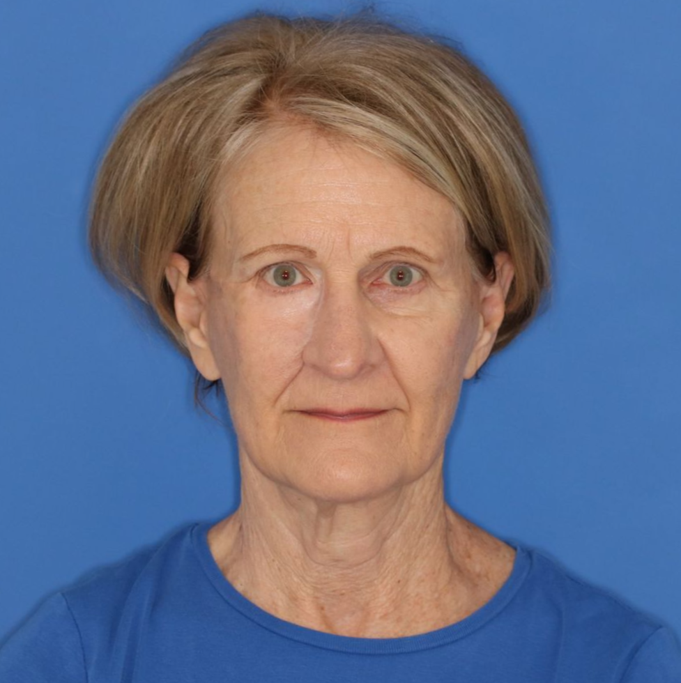 Woman posing for a before photo before receiving CO2 laser treatment
