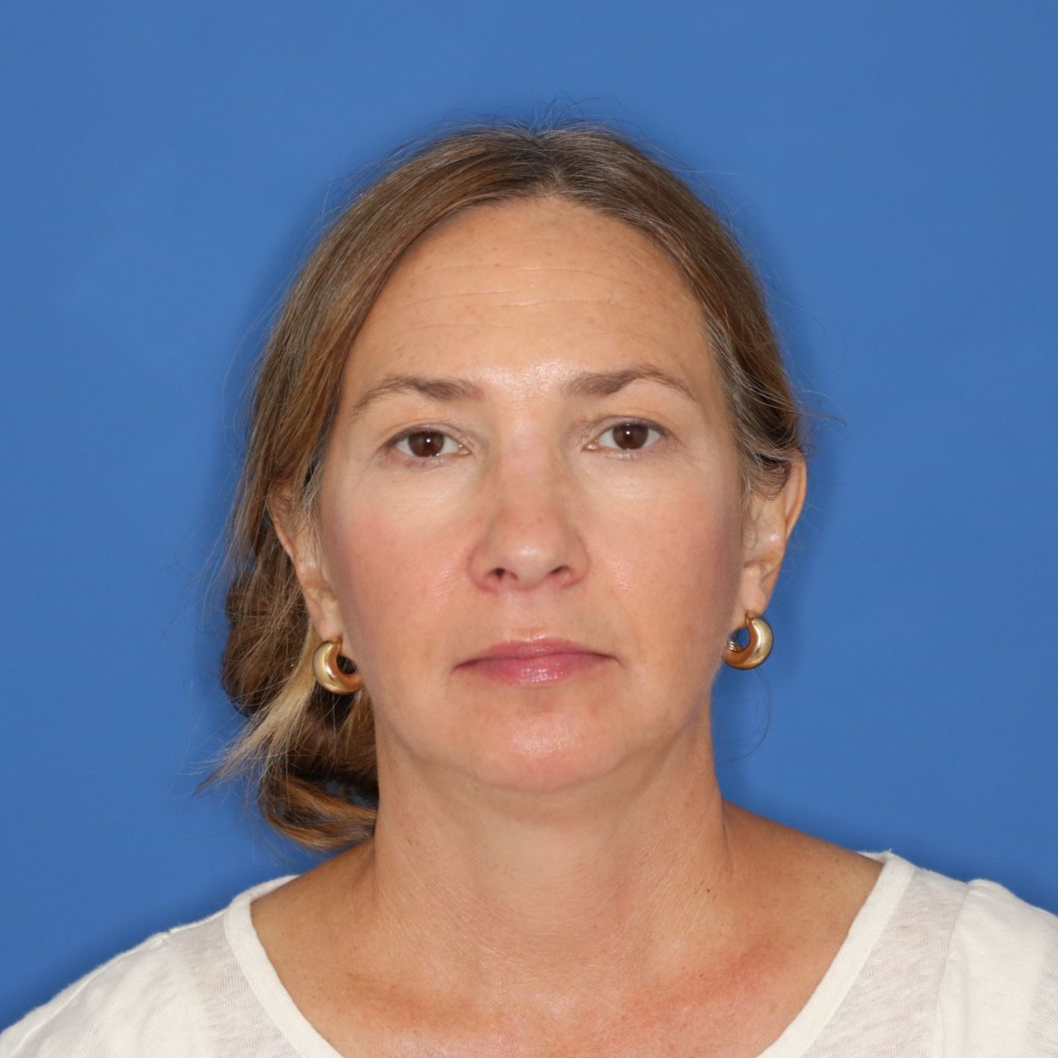 A woman posing for a before photo for CO2 laser treatment