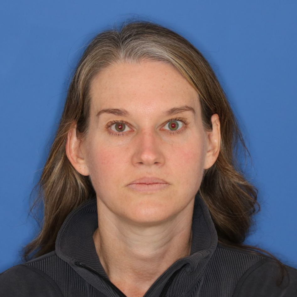 A woman in front of a blue background before receiving CO2 laser treatment