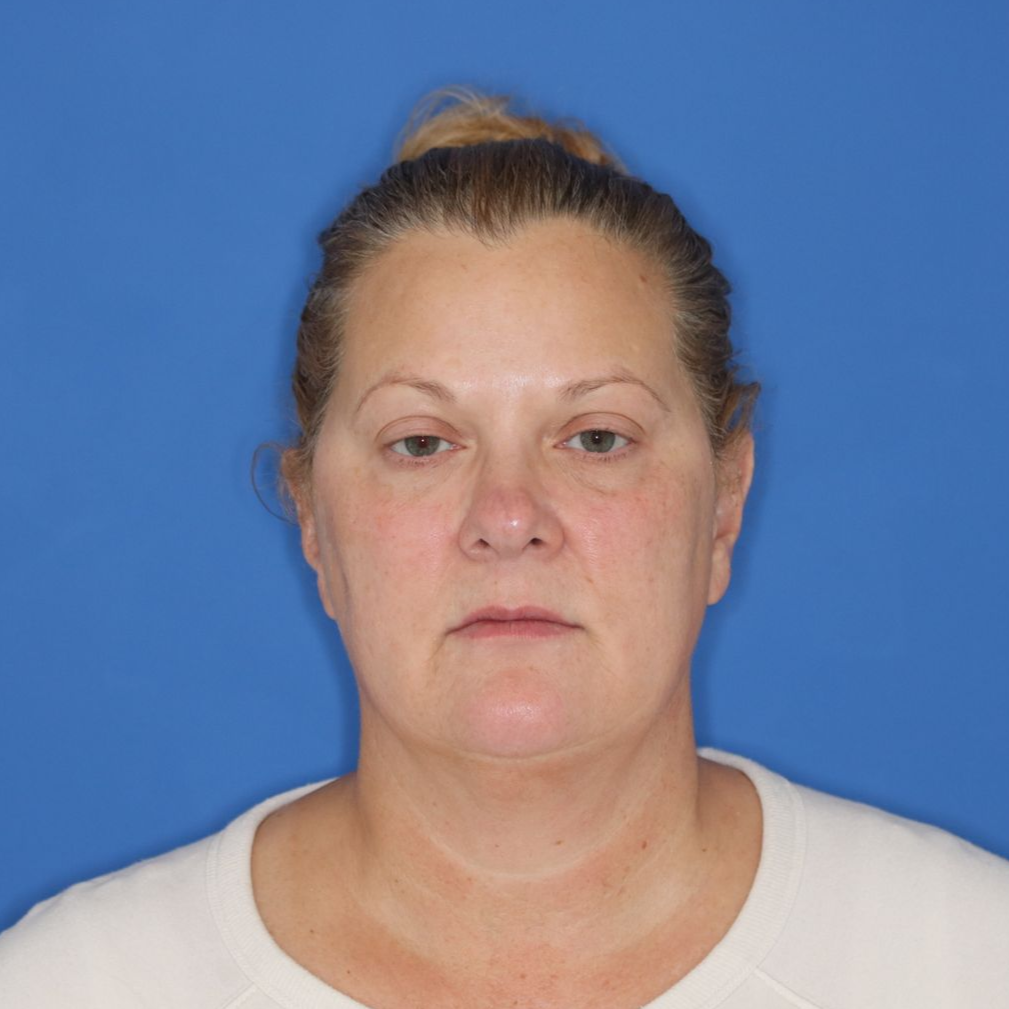 Woman before receiving CO2 laser treatment