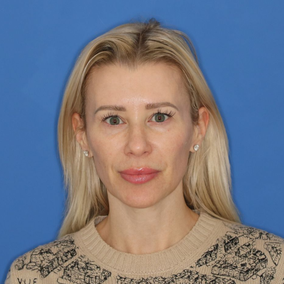 Blonde woman posing in front of a blue background before receiving CO2 laser treatment