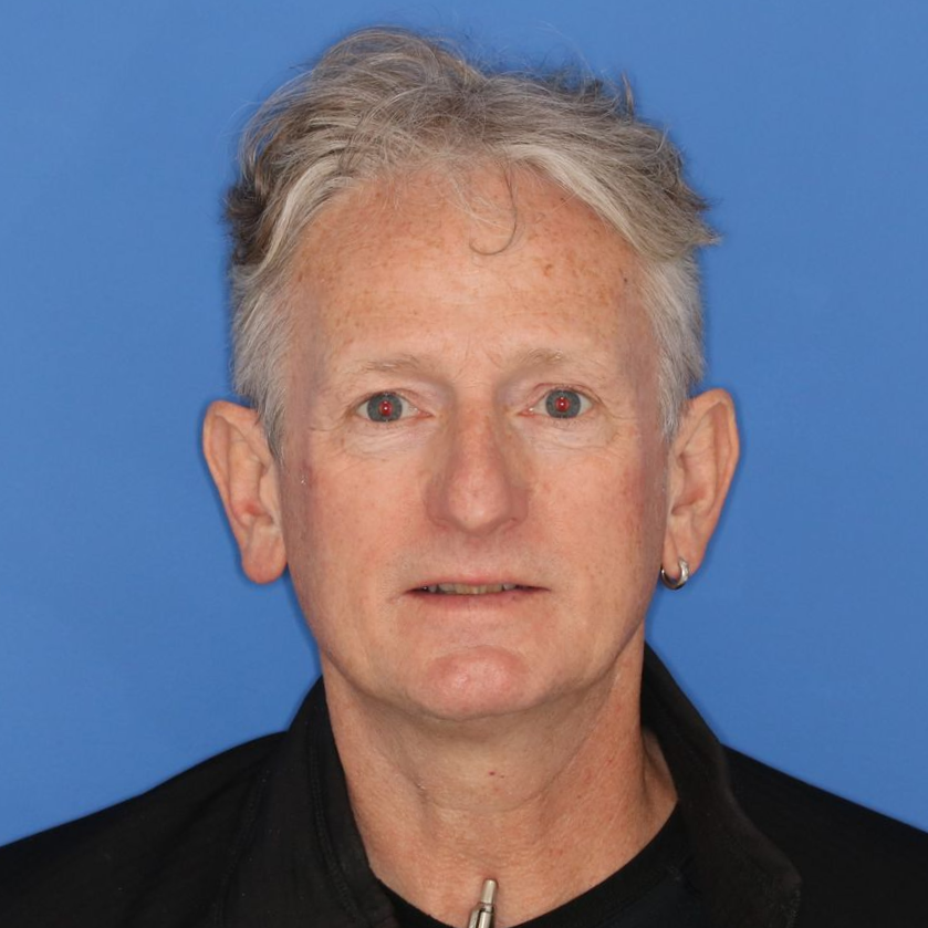 57 year old male before undergoing a rhinoplasty