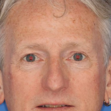 Close up of a 57 year old male in front of a blue background before blepharoplasty